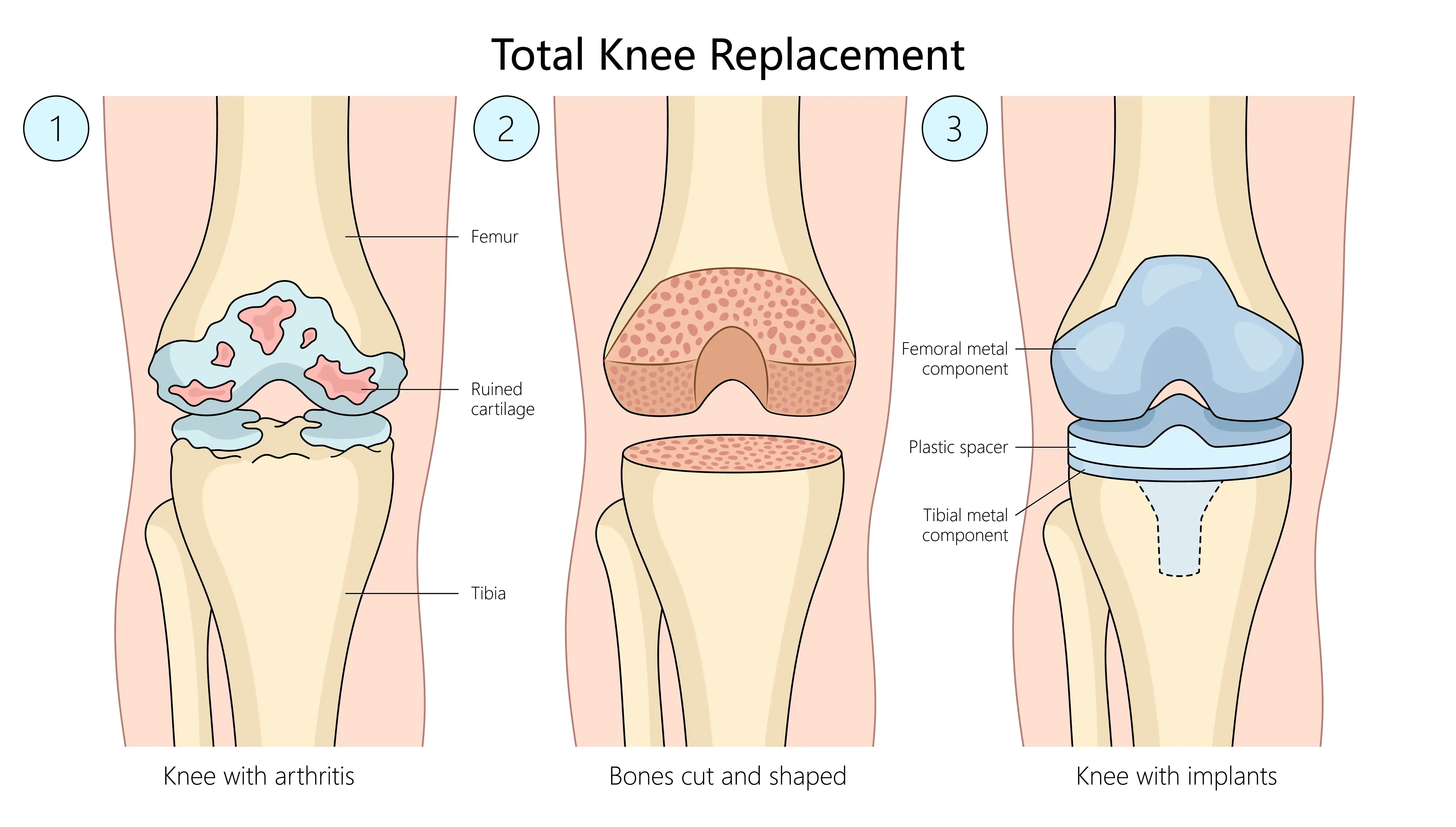 Total-Knee-Replacement