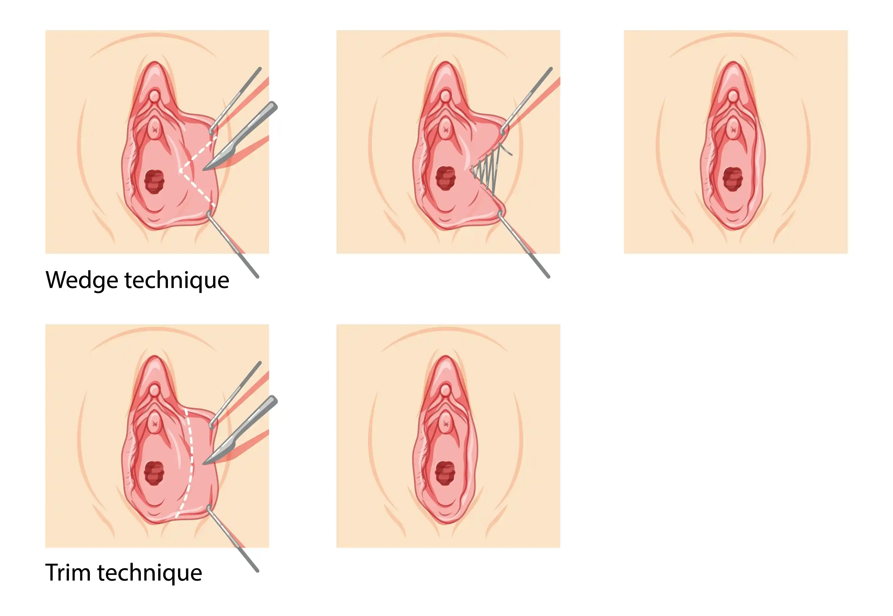 Labiaplasty