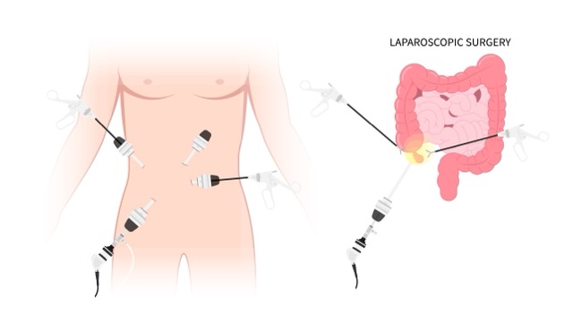 Laparoscopic-Surgery