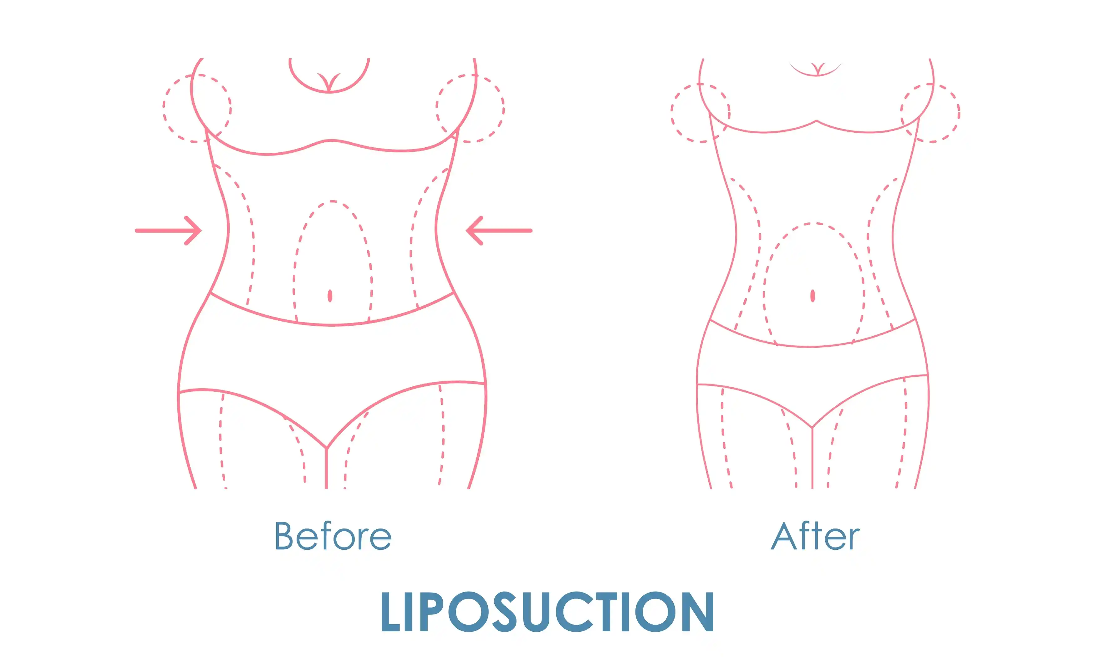 Liposuction