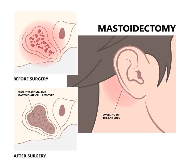 Mastoidectomy