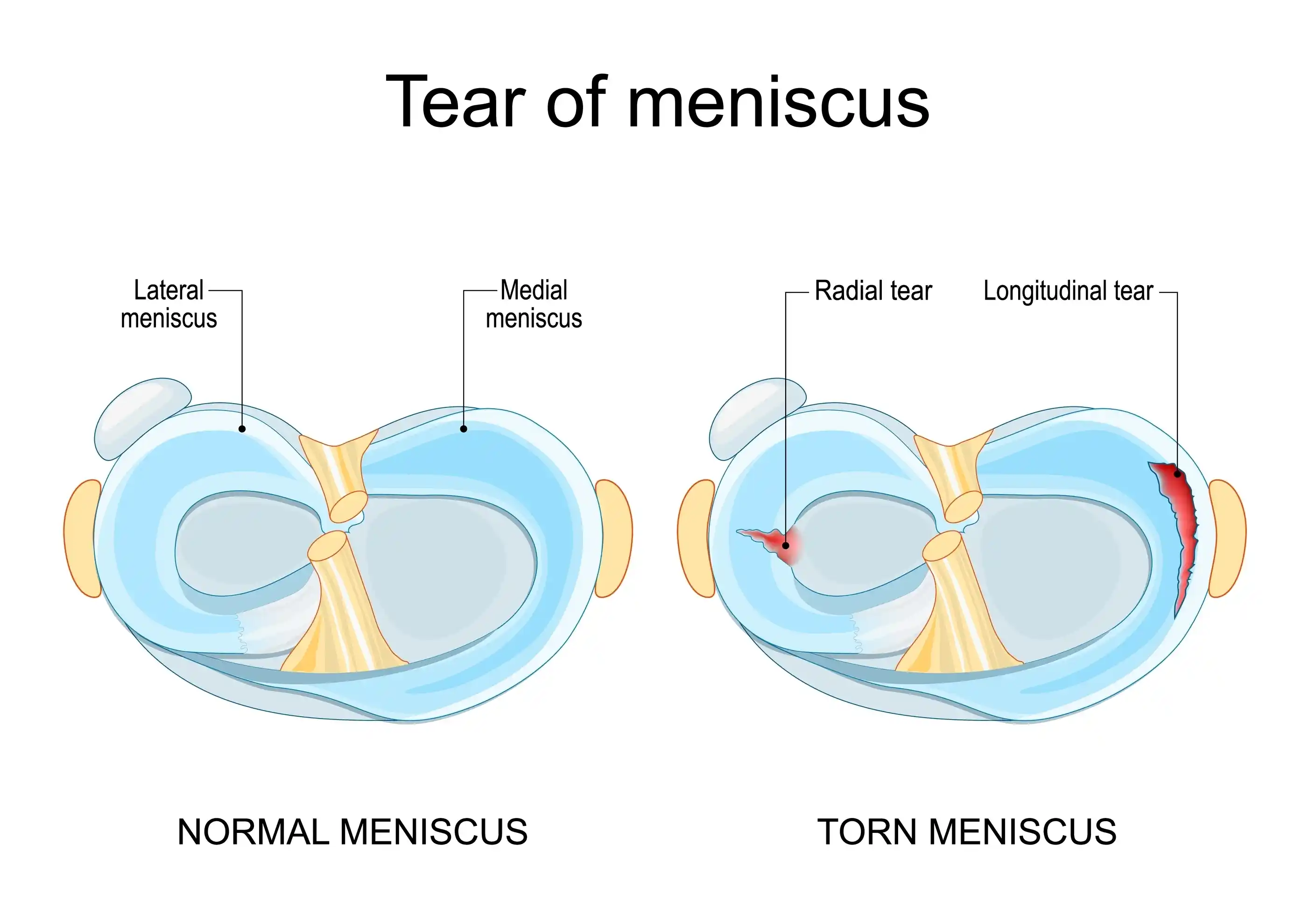 Meniscus-Tear