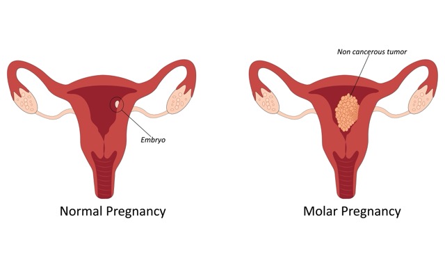 Molar-Pregnancy