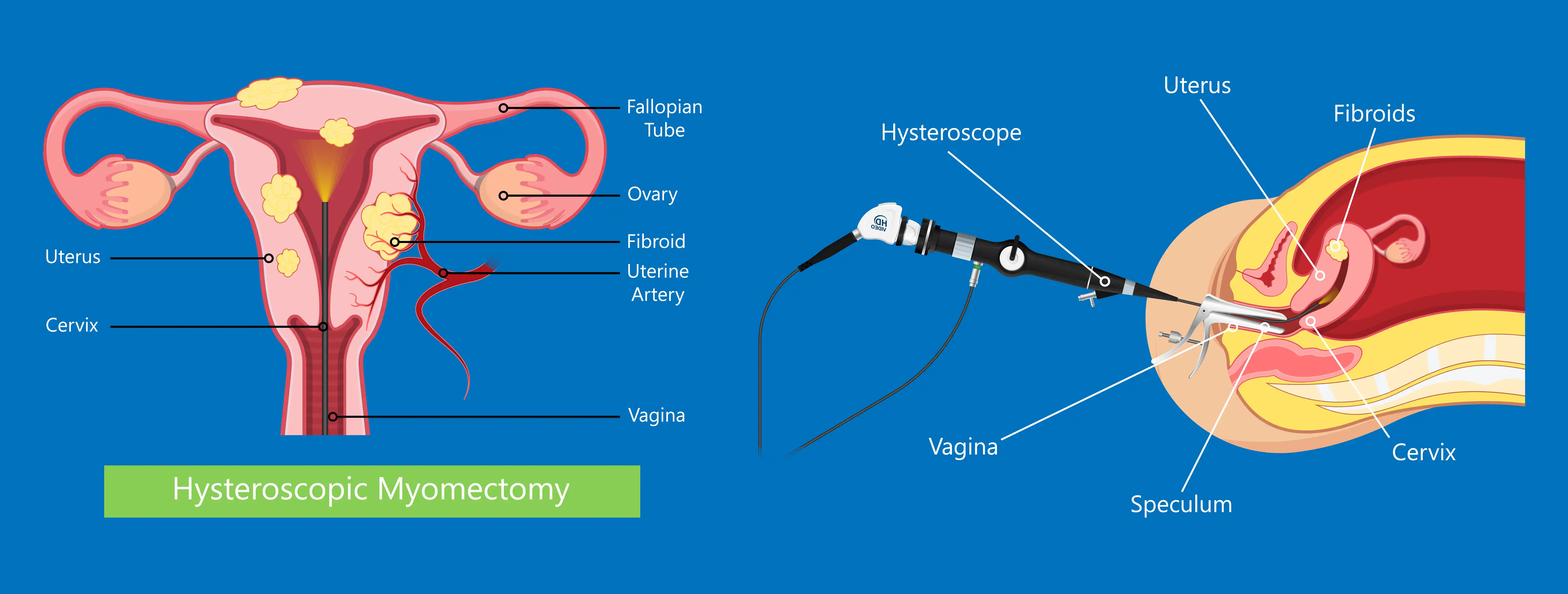 Myomectomy