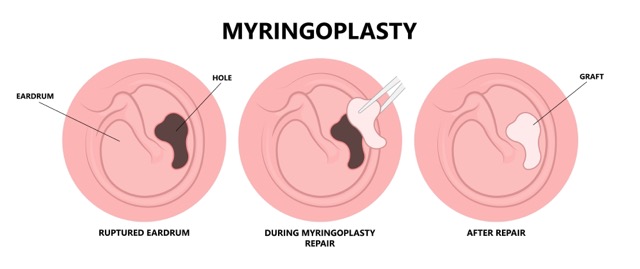 Myringoplasty