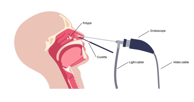 Nasal-Endoscopy