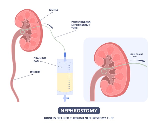Nephrostomy