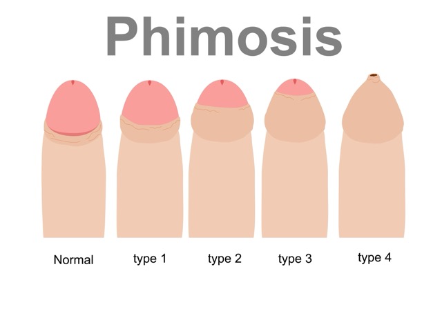 Paraphimosis
