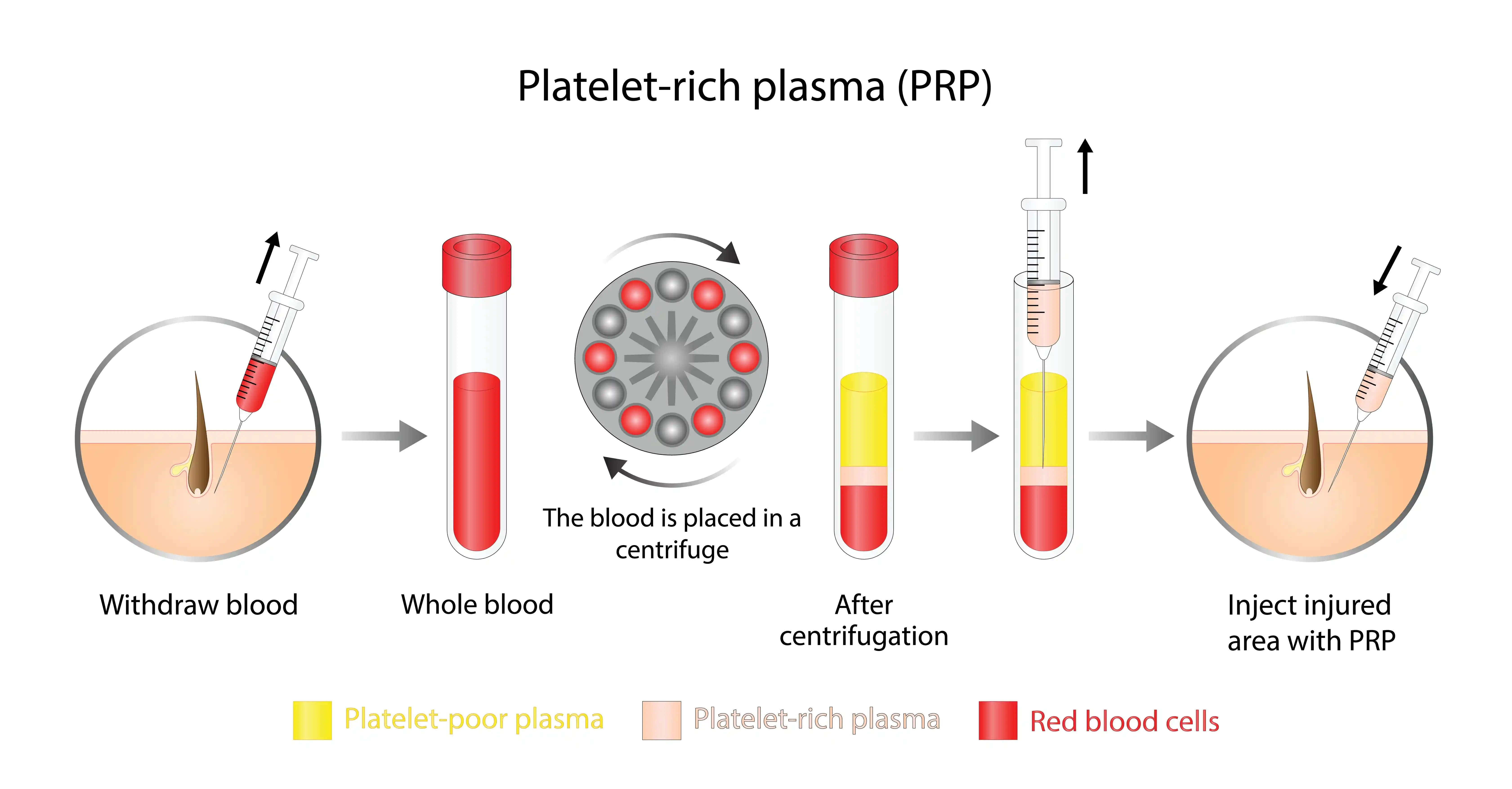 Platelet-Rich-Plasma-Prp