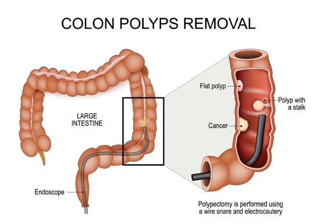Polypectomy