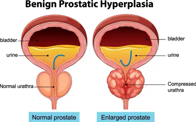 Prostate-Enlargement
