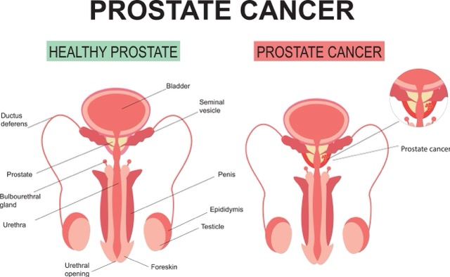 Prostatectomy