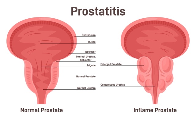 Prostatitis