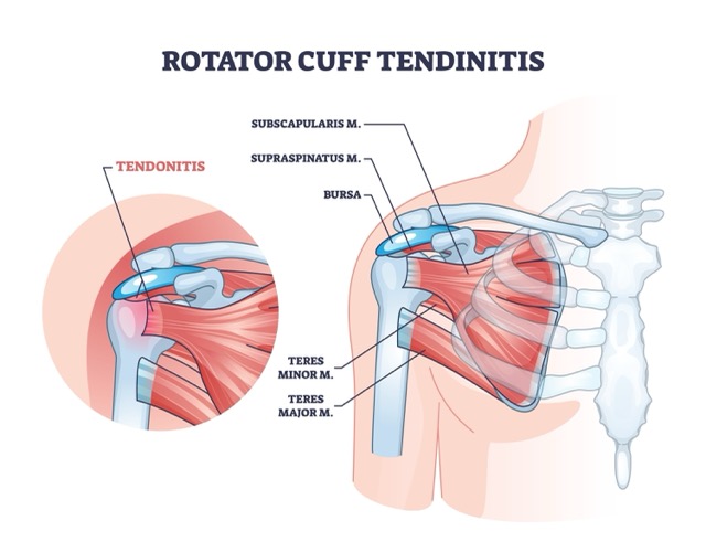Rotator-Cuff-Repair