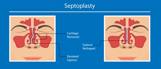 Septoplasty