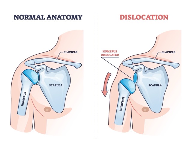 Shoulder-Dislocation