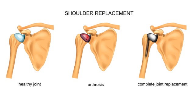 Shoulder-Replacement