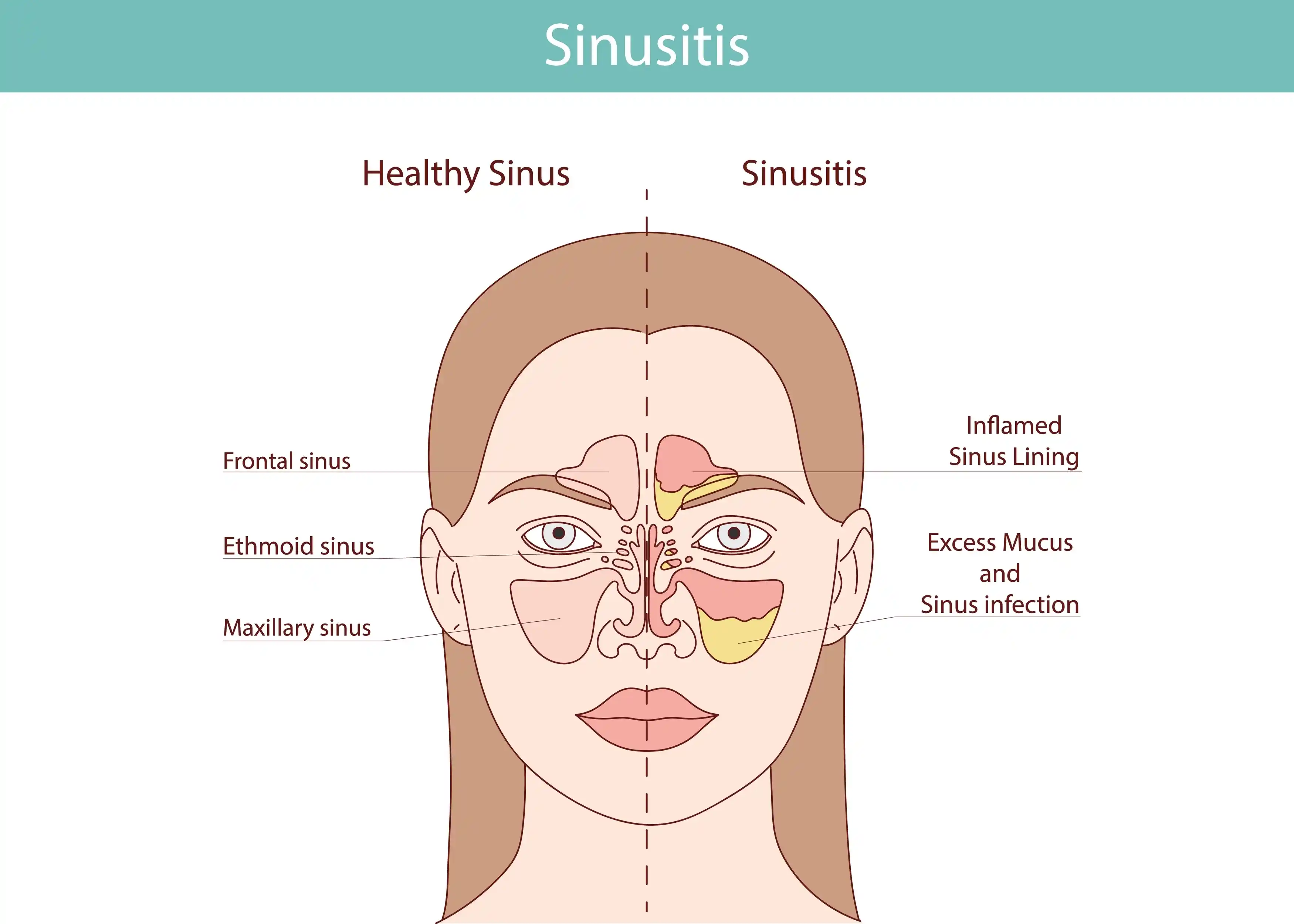 Sinusitis