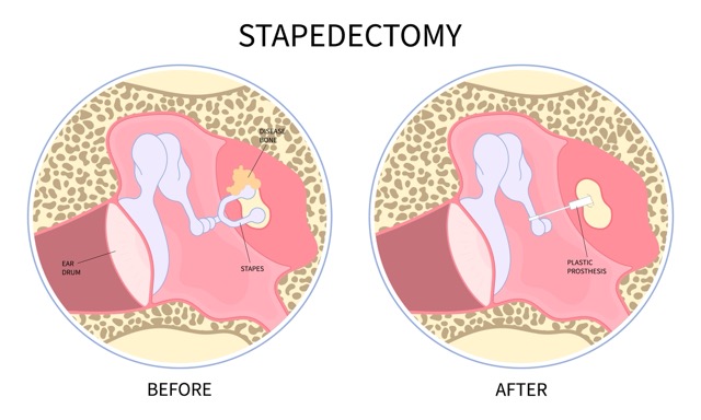 Stapedectomy