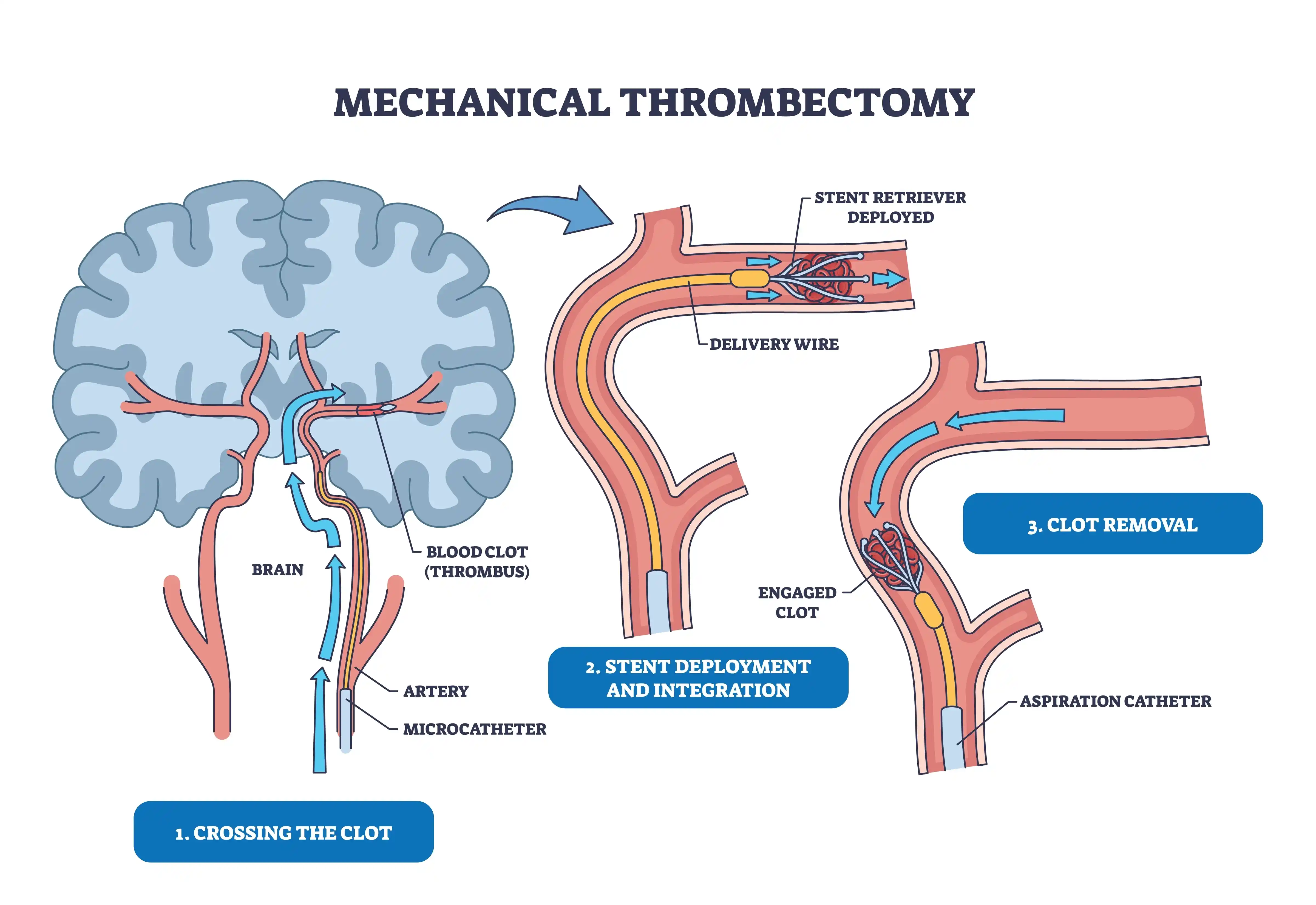 Thrombectomy