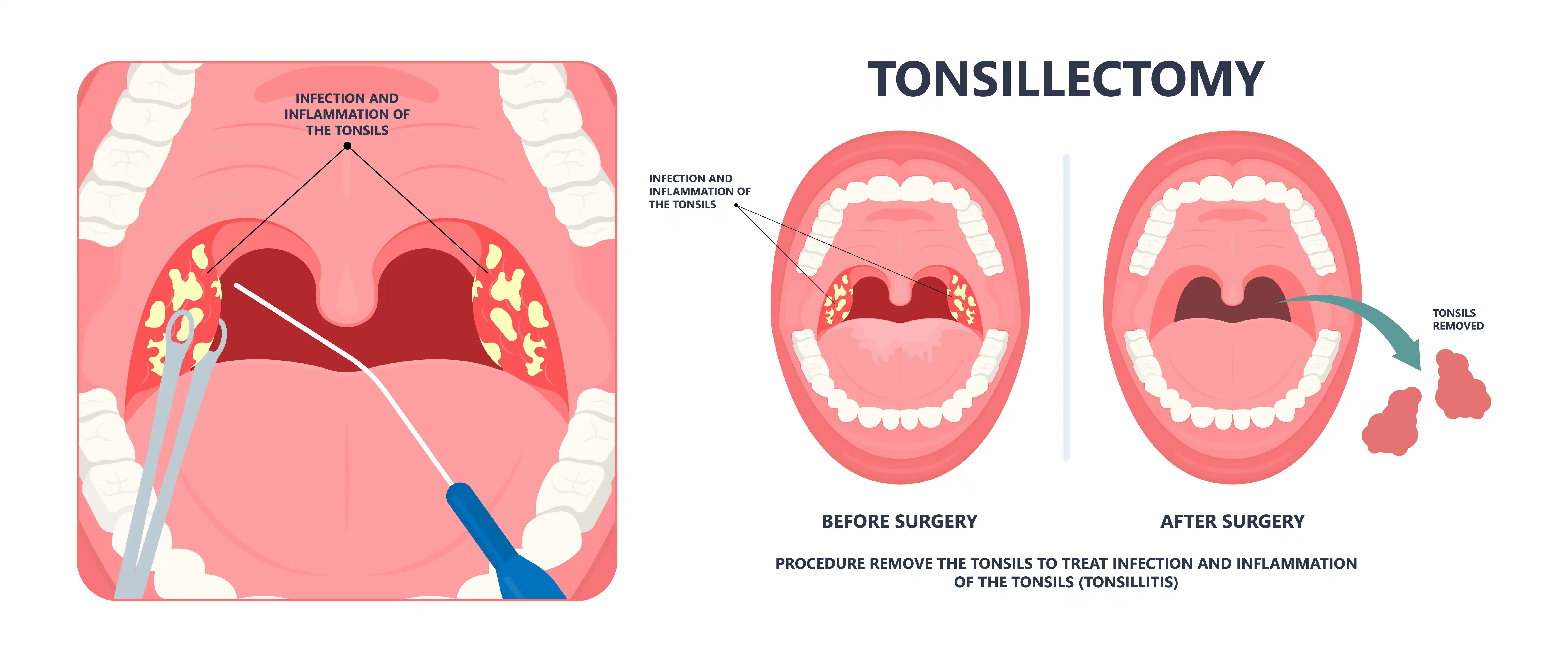 Tonsillectomy