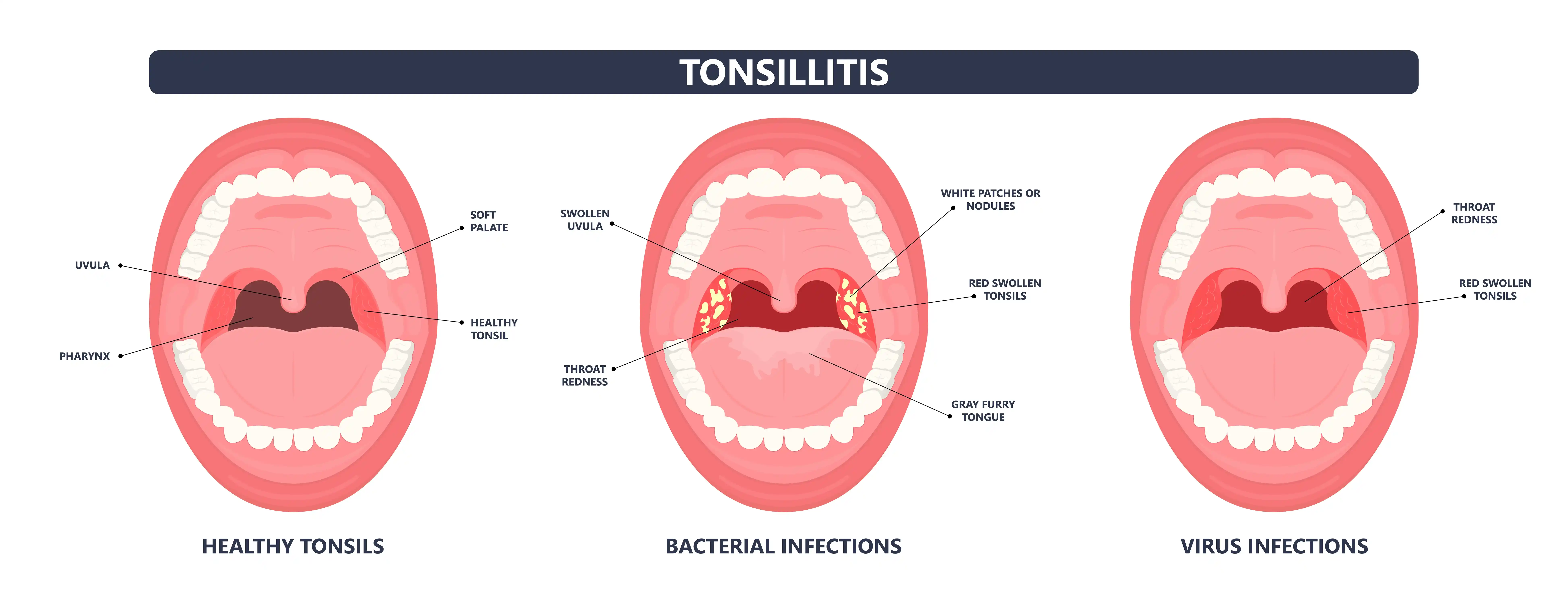 Tonsillitis