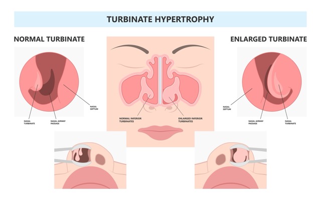 Turbinoplasty