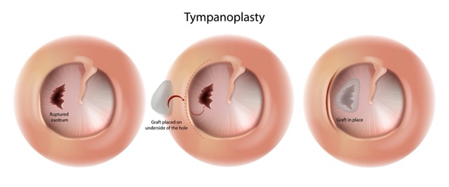 Tympanoplasty