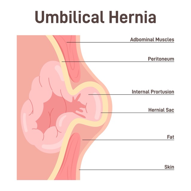 Umbilical-Hernia