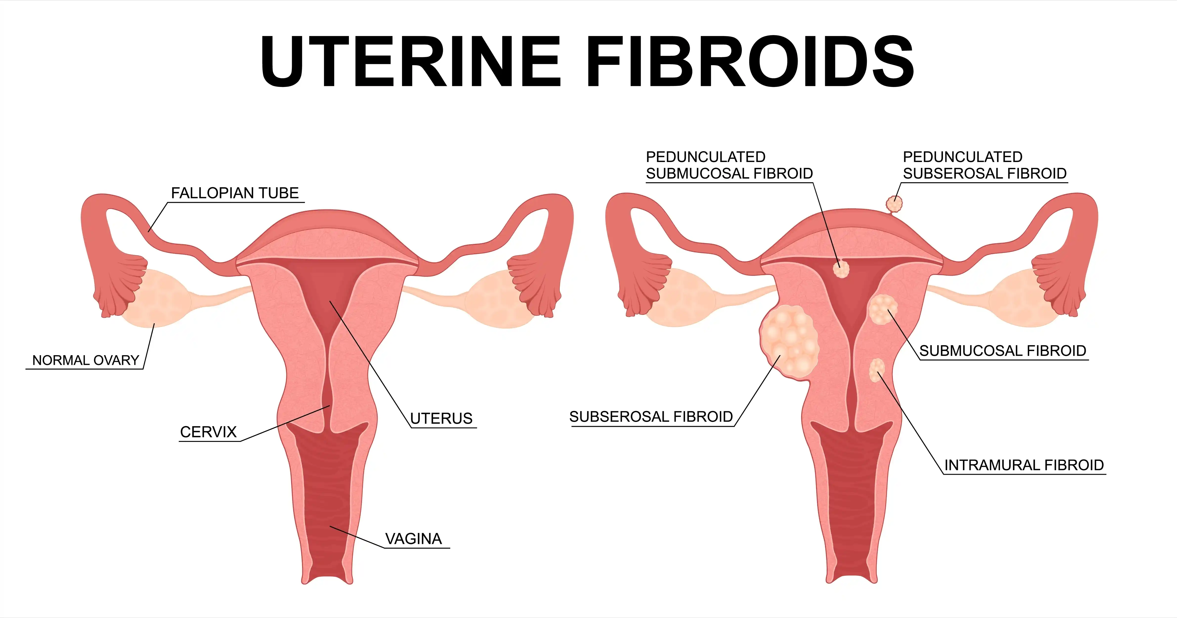 Uterine-Fibroid