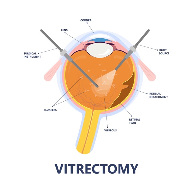 Vitrectomy