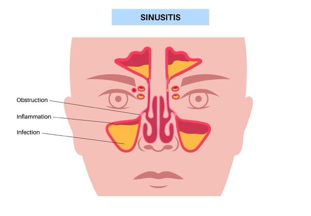 acute-rhinosinusitis