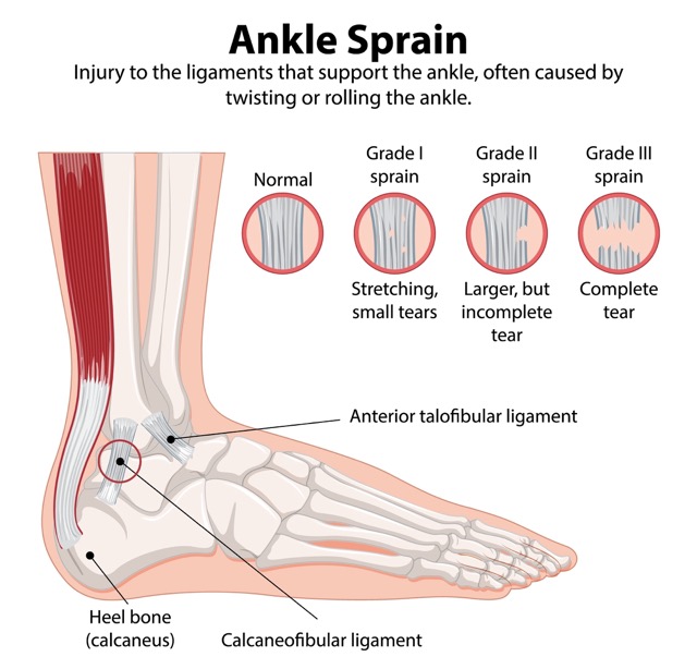 ankle-sprain