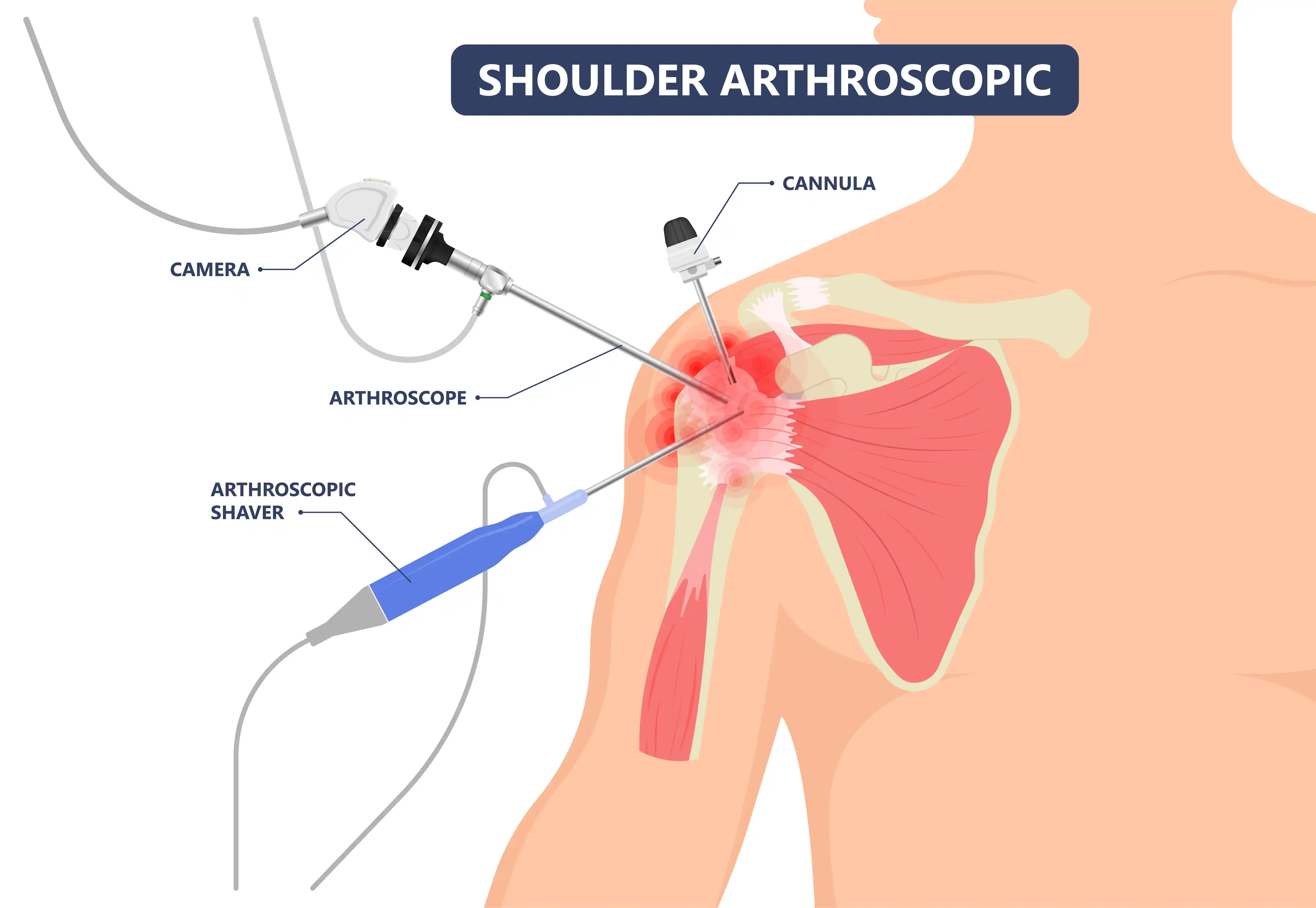 Shoulder-Arthroscopy