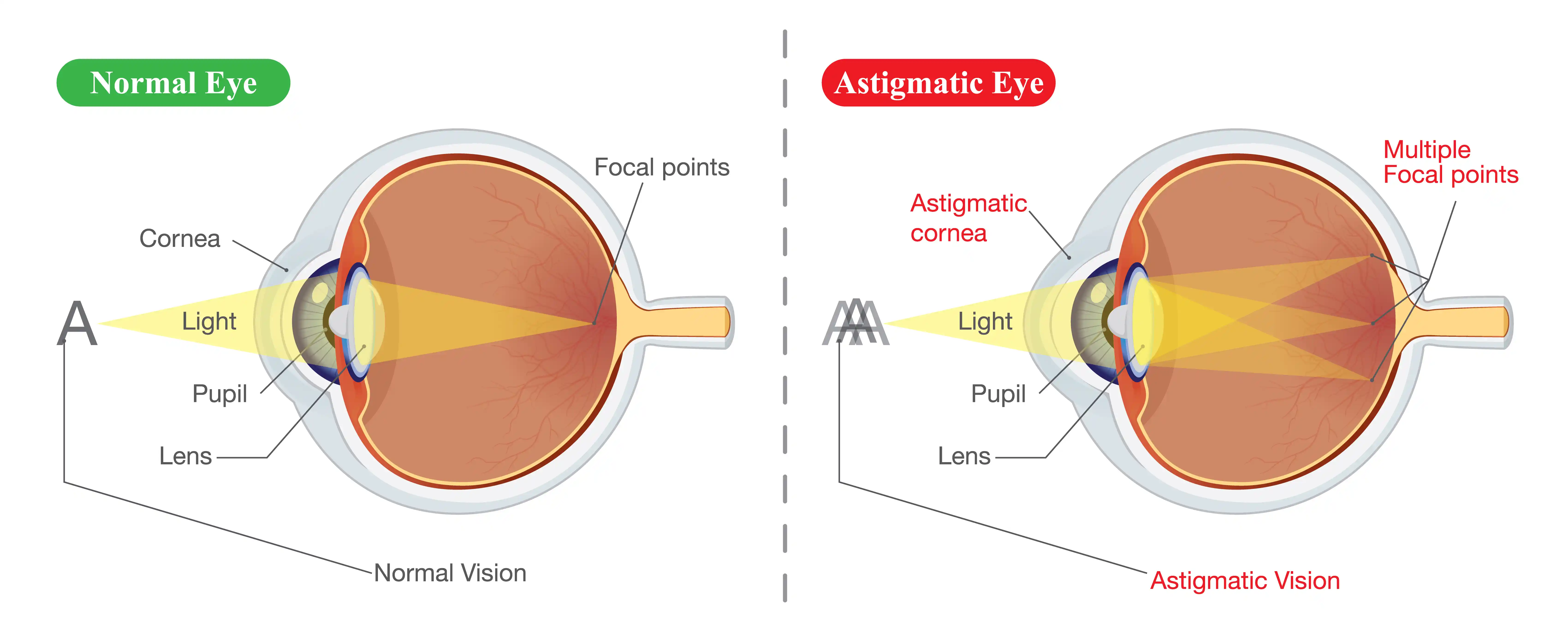 astigmatism