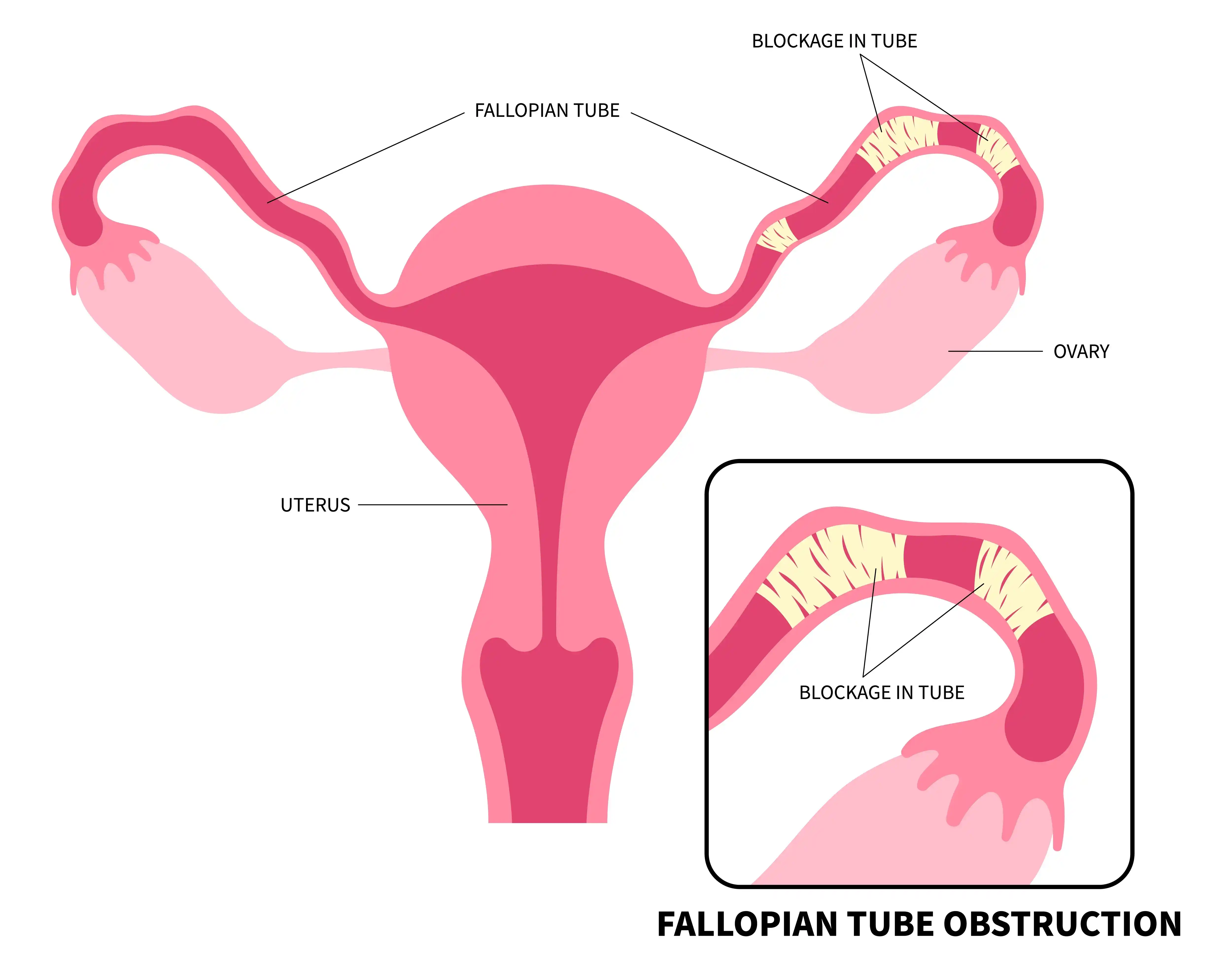 blocked-fallopian-tubes