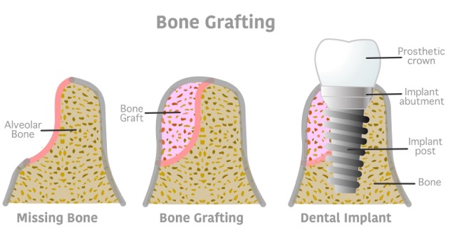 bone-grafting