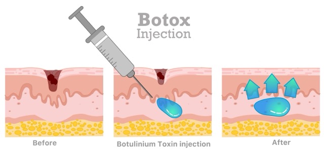 botox-injection