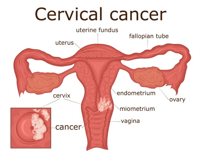 cervical-fibroid