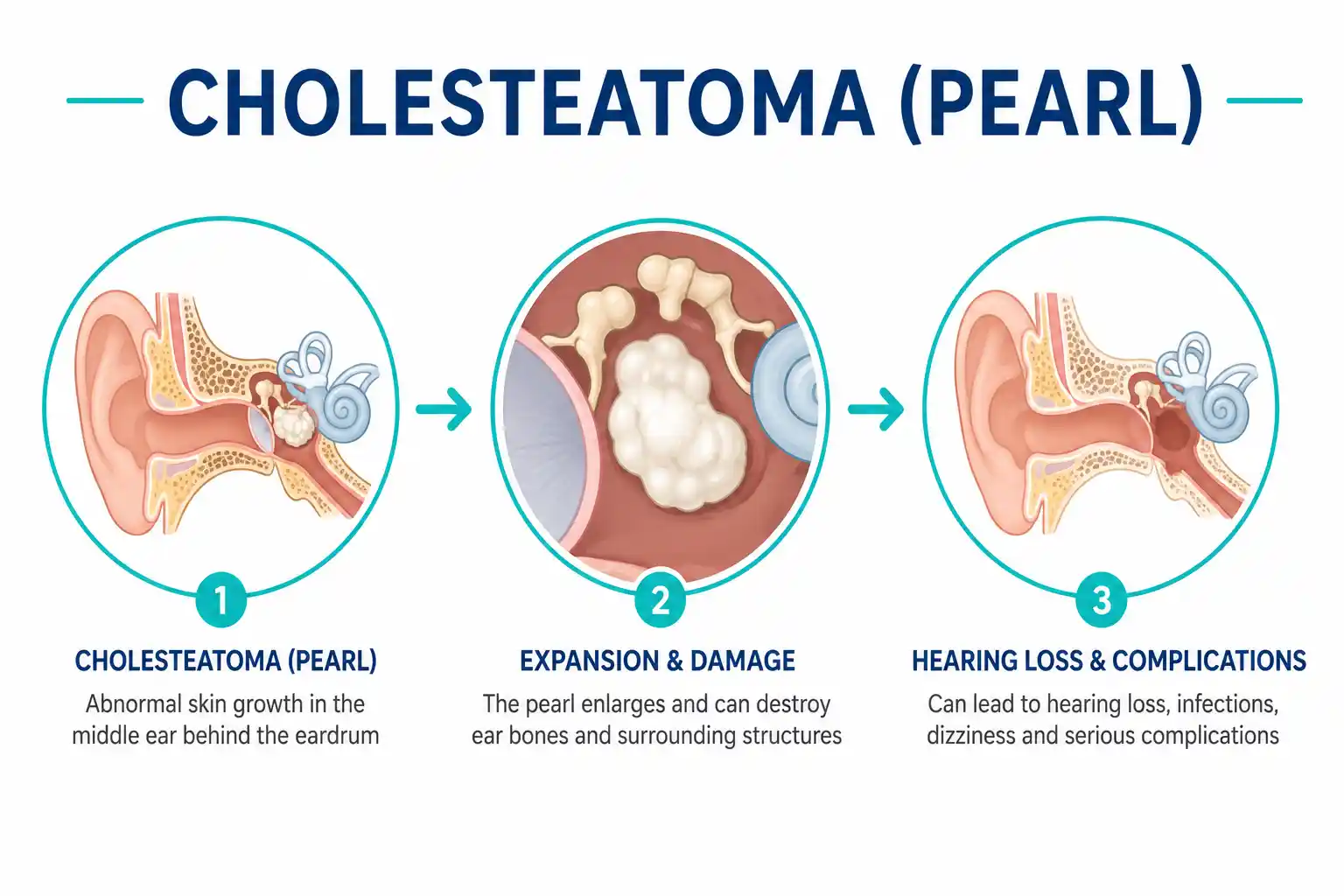 cholesteatoma-pearl
