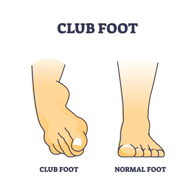 clubfoot-surgery