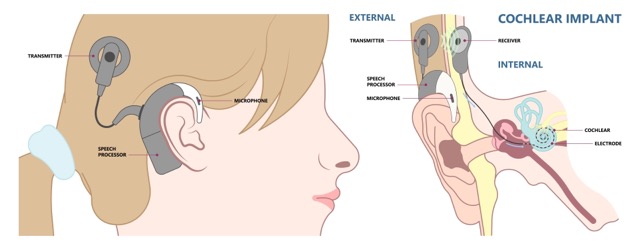 cochlear-implant