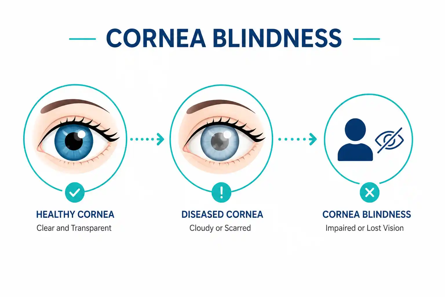 cornea-blindness