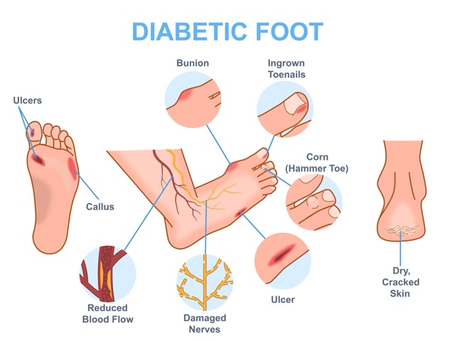 diabetic-foot-cellulitis