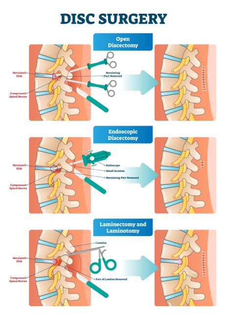 Discectomy