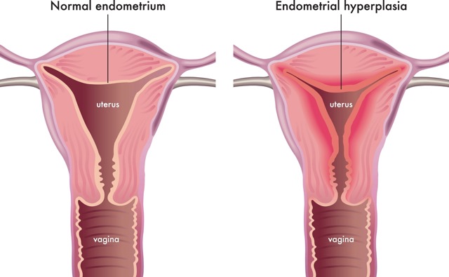 endometrial-hyperplasia