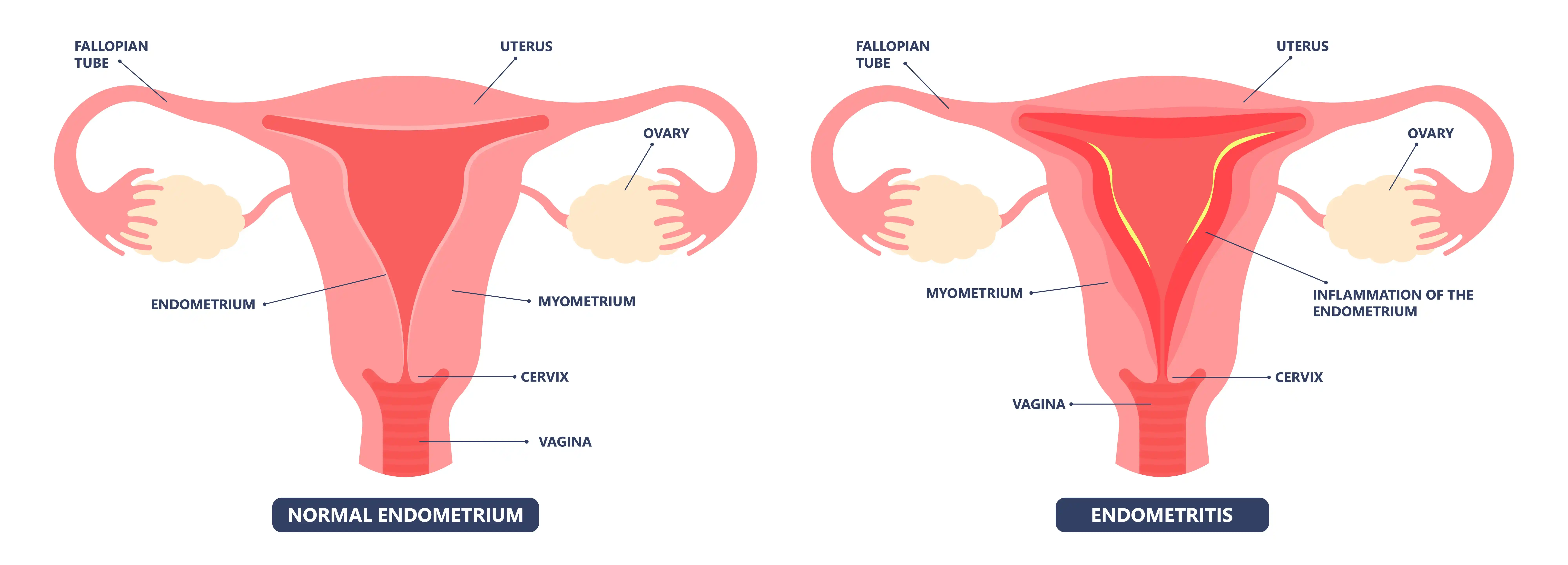 endometrioma