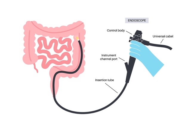 endoscopic-revision