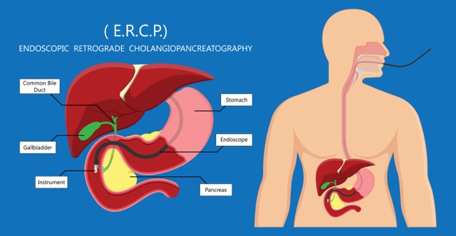 ercp