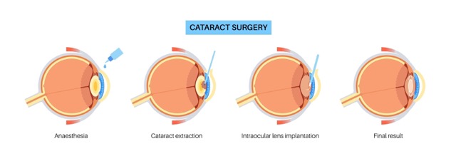 extracapsular-cataract-extraction